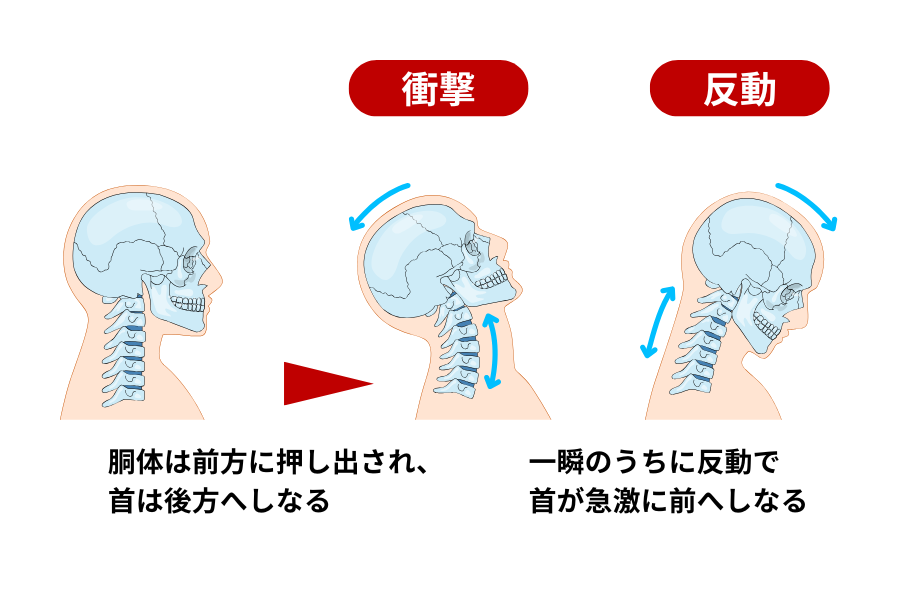 むち打ち症